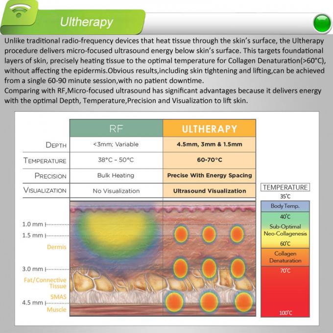 ultherapy HIFU의 ulthera 체계, 주름 제거 드는, 피부 수출, 2years 보장의 경험 5 년